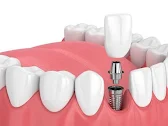 Dental Implant Treatment